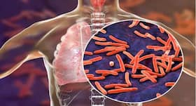 Correlation Between Tuberculosis and Chronic Respiratory Diseases Explained Correlation Between Tuberculosis and Chronic Respiratory Diseases Explained