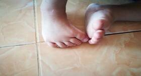 Donate Used Clubfoot Braces to India’s First Brace Bank