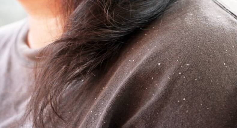 Follow these home remedies to tackle dandruff