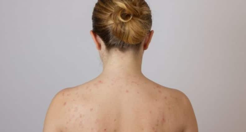 This is how you can tackle folliculitis naturally