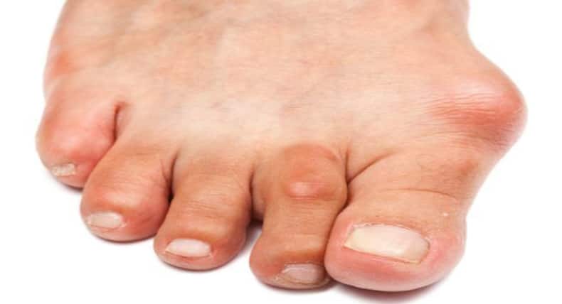 This is how you can manage gout and avoid its triggers
