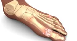 This is how you can manage gout and avoid its triggers