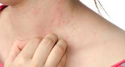 Floods can increase the risk of skin infection among humans