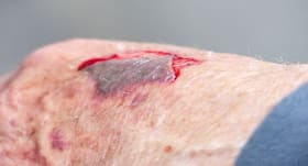 Go the natural way to care for abrasions at home