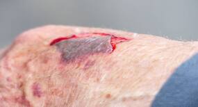 Go the natural way to care for abrasions at home