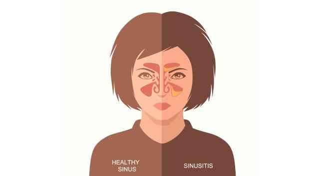 Everything You Want To Know About Sinusitis Or Sinus Infection Or