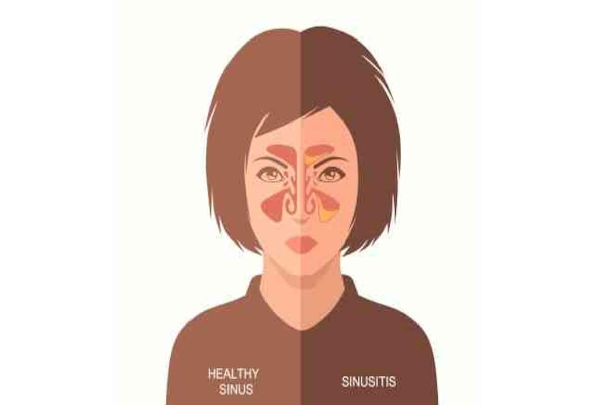 Everything You Want To Know About Sinusitis Or Sinus Infection Or Rhinosinusitis Thehealthsite Com