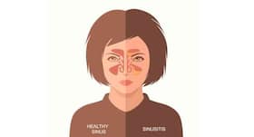 Everything you want to know about sinusitis or sinus infection or rhinosinusitis