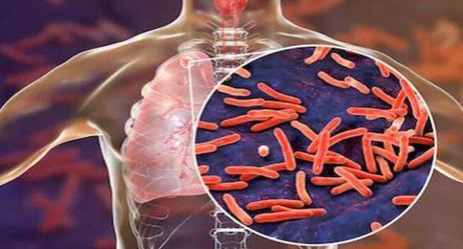 world-tuberculosis-day