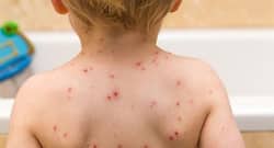 Natural remedies to soothe the symptoms of chicken pox