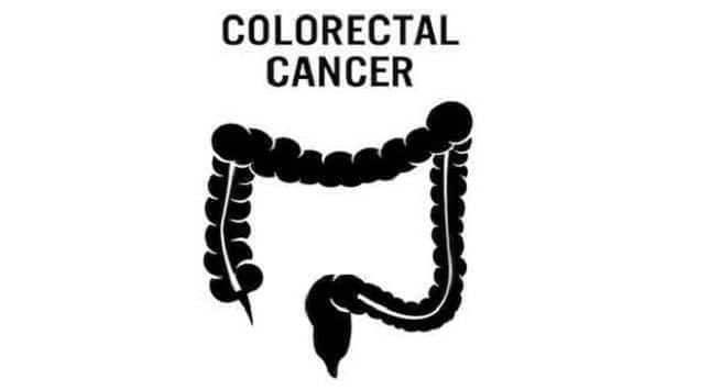 Weakness, Fatigue And Weight Loss: 3 Symptoms Of Colon Cancer