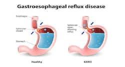 Follow these foods habits if you have GERD