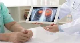 Newly developed model can predict lung cancer survival
