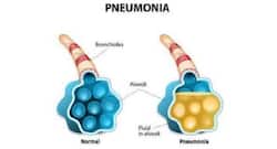 Know how to get relief from pneumonia symptoms at home