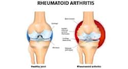 Manage your rheumatoid arthritis symptoms with these essential oils