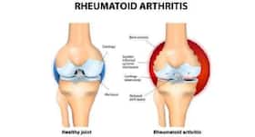 Manage your rheumatoid arthritis symptoms with these essential oils