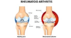 Manage your rheumatoid arthritis symptoms with these essential oils