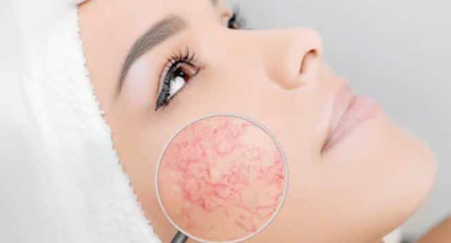 Rosacea Facial skin disorders Treatment in hindi 