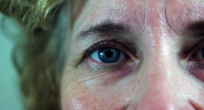 Rosacea Facial skin disorders symptoms 