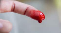 Minor cuts and injuries can cause bleeding: Know how to stop it naturally