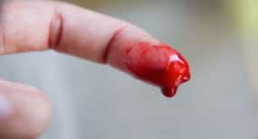 On World Hemophilia Day, know about the 'missing factors' in your blood