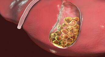 Know if you are having a gallbladder attack | TheHealthSite.com