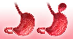Novel app may predict hernia risk after abdominal surgery: Study