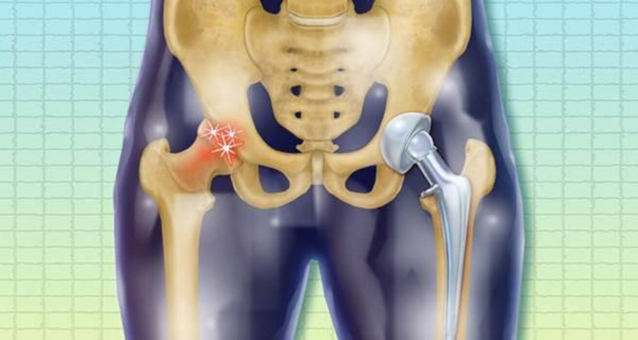 Can Knee Arthritis Increase Your Risk Of Getting A Hip Fracture?