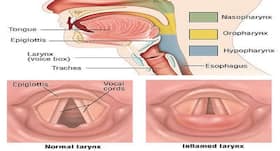 World Voice Day 2019: Natural remedies for laryngitis World Voice Day 2019: Natural remedies for laryngitis