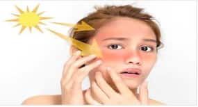 स्किन समर केयर : सन एक्सपोजर से त्वचा पड़ सकती है काली, अपनाएं शहनाज हुसैन के ये टिप्स