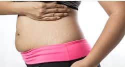 Tired of hiding stretch marks? Try these home remedies to get rid of those ‘ugly’ lines