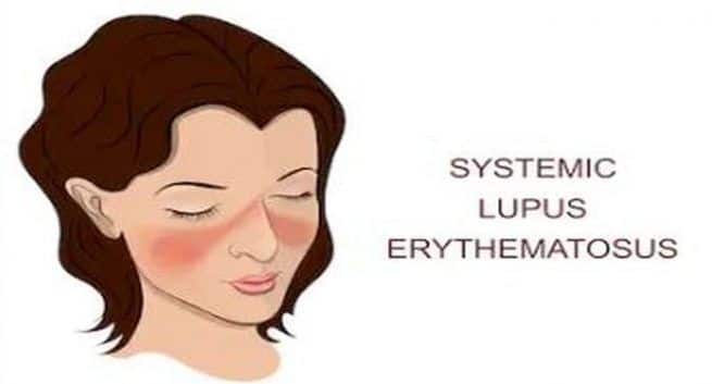 butterfly-rashes