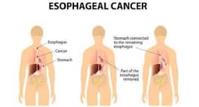 Women with stomach cancer live longer than men patients: Study Women with stomach cancer live longer than men patients: Study