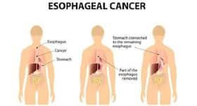 Less chemotherapy effective for older patients with stomach cancer