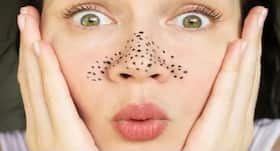 Don’t squeeze or scrub blackheads: Here are 5 natural ways to clear the dark bumps