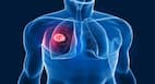 Unlocking Early Detection: How Are Diagnostic Labs Revolutionizing Lung Cancer Testing?