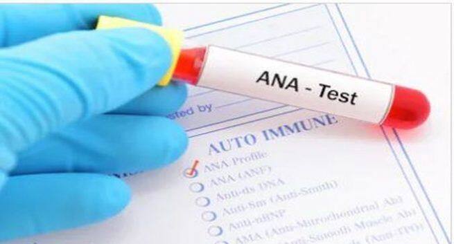 Test For Lupus Disease 655x353 
