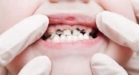 Want to prevent tooth decay? Bone broth is your answer Want to prevent tooth decay? Bone broth is your answer