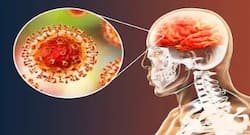 Acute Encephalitis Syndrome kills 53 kids in north Bihar