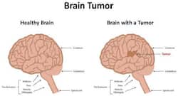World Brain Tumour Day 2019: Here is how to fix the side-effects of treatment