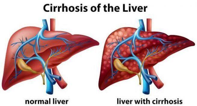 Cirrhosis