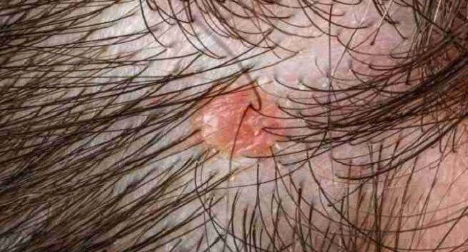 Scalp infections