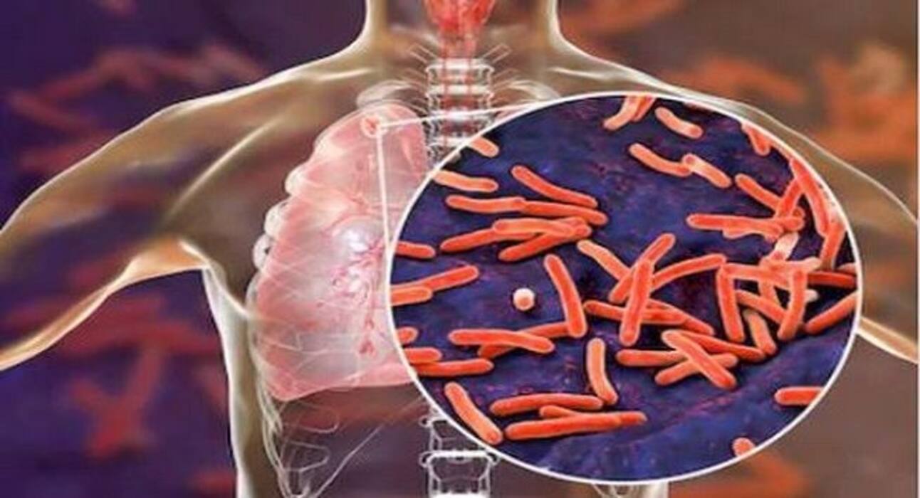 6 infections that come with HIV/AIDS