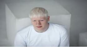 International Albinism Awareness Day : जानें, क्या है एल्बिनिज्म, कारण, लक्षण और इलाज