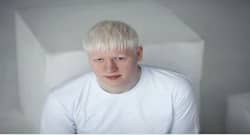 International Albinism Awareness Day: Everything you need to know about this condition