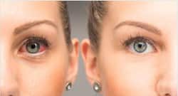 Conjunctivitis : आंखें लाल हैं तो हो सकता है कंजंक्टिवाइटिस, जानें लक्षण, कारण और उपचार