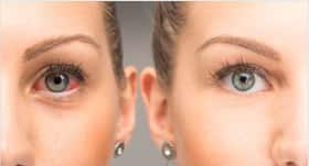 Conjunctivitis : आंखें लाल हैं तो हो सकता है कंजंक्टिवाइटिस, जानें लक्षण, कारण और उपचार Conjunctivitis : आंखें लाल हैं तो हो सकता है कंजंक्टिवाइटिस, जानें लक्षण, कारण और उपचार