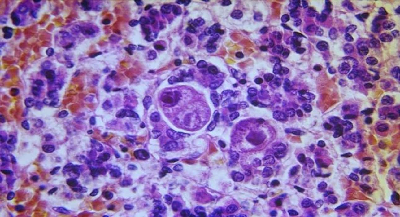 6 infections that come with HIV/AIDS