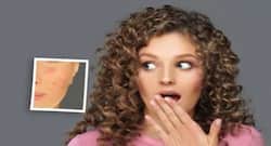 मुंहासों के दाग हटाने के लिए अपनाएं ये होम रेमेडीज