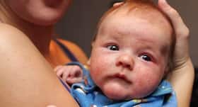 Eczema: एक्जिमा ग्रस्‍त शिशुओं में रहता है 'एटोपिक मार्च' का जोखिम